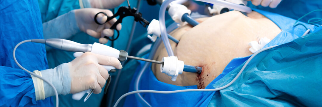 A Surgeon In Latex Gloves And A Blue Uniform Holds Special Medical Instruments During A Laparoscopic Operation. Minimally Invasive Surgery. Wide Image. 