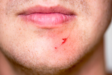 Small wound or cut on the skin, wound on face of man, close-up of chin