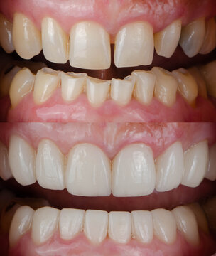 Before and After treatment of dental ceramic veneer and crown (Dental makeover cases)