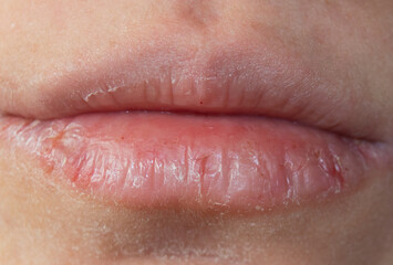 chapped and dehydrated dry lips. chapped lips in winter.Close-up pale female lips cracked