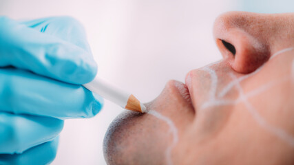 Dermal Fillers for Men. Marking Man’s Face Before Dermal Filler Treatment