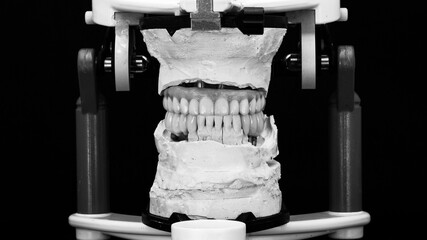 upper jaw prosthesis and ceramic crowns on black and white models © Dental Pro Content