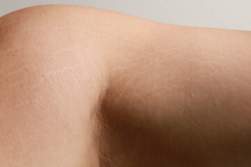 Body striae, stretch marks on an Asian adult arm.
