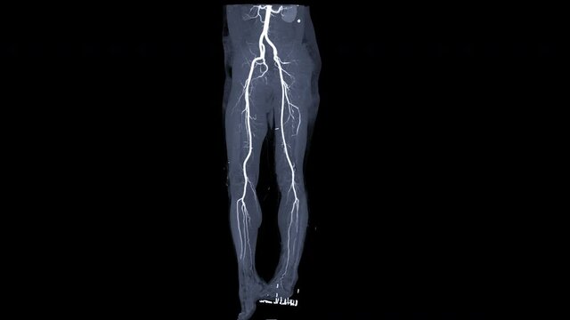 CTA femoral artery runn off angiography view turn around on the screen for detect peripheral arterial disease.