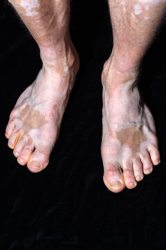 pieds avec la maladie g&eacute;n&eacute;tique du vitiligo