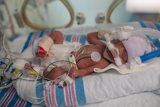 Premature newborn 7-day-old baby sleeping in incubator in intensive care with health monitor lines connected