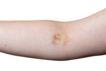 hand of man faceless elbow with bruise damage after blood test close-up isolated on white background.