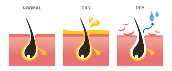 Skin cross section of pore types. Normal, oily, and dry pores. Pale colored illustration in flat cartoon style.