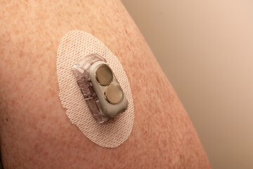CGM - Continuous glucose monitoring: sensor installed on the upper arm. Transmitter with replaced...