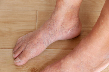 Focus of leg that is varicose veins and wrinkled skin of the elderly asian woman, Various illnesses of the elderly and good health concept.