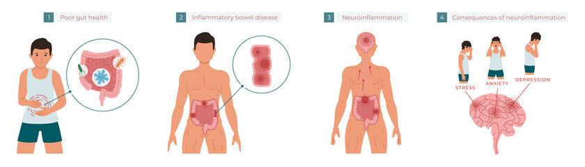 Poor gut health leads to chronic inflammation, which in turn leads to neuroinflammation, which can cause stress, anxiety, and depression. Vector illustration