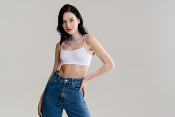Young brunette woman with vitiligo skin posing