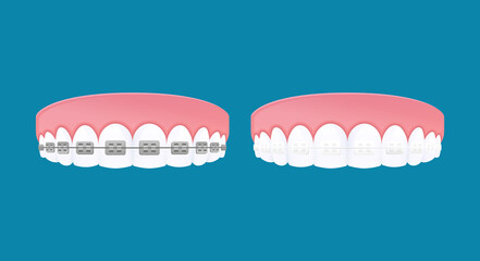 Types of braces system. Metal and Clear brackets teeth. Vector cartoon style.