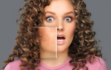 Post-Acne Marks /Treating Acne Scars.Acne Scar Removal