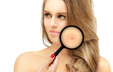 Post-Acne Marks /Treating Acne Scars.Acne Scar Removal.