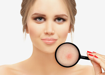 Post-Acne Marks /Treating Acne Scars.Acne Scar Removal.