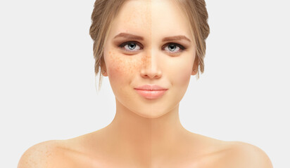 Freckles. Model's face divided in two parts