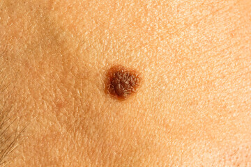 Mole on the cheek. Dermatology, surgery, milanoma, melanin. Skin diseases, acne. Clean skin, care and creams.