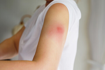 Vaccination reaction on arm of woman after injection of covid corona virus vaccine. Swollen part, red puncture site. Unrecognizable person.