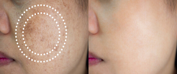 Image before and after spot melasma pigmentation facial treatment on face asian woman. Problem...