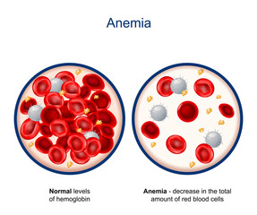 Anemia. Close-up of blood vessel with erythrocyte, platelets and white blood cells (lymphocytes)