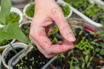 Psoriasis of the skin on a woman's hand.