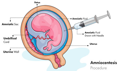 amniocenteses illustration. 