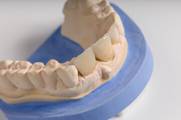 Close up artificial dentition on dental imprint in a dental laboratory on a workbench ready for use