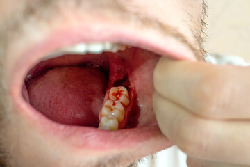 Close-up of a tooth gap in a male mouth for a dental implant with fresh open wound and blood,...
