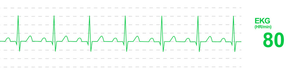 Electrocardiogram (ECG or EKG) monitoring. EKG monitor screen. Wave and HR per min parameters 