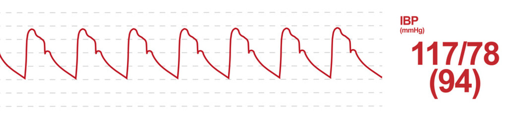 Invasive Blood Pressure(IBP) monitoring screen. Arterial pulse Waveform monitor. 