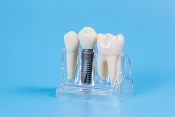 Dental crowns, imitation of a dental prosthesis of a dental bridge with implant