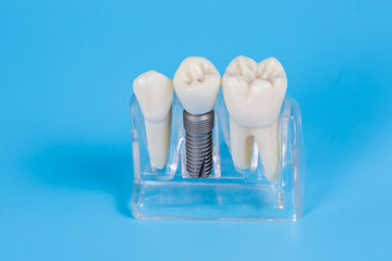 Dental crowns, imitation of a dental prosthesis of a dental bridge with implant