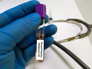 Biochemist hold a syringe with Pleural fluid sample, which is ready for biochemical test (Glucose, Protein, ADA). Cytology, Malignant cell. Closeup