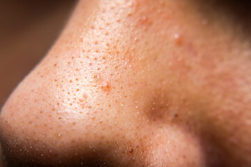 Closed-up of pimple blackheads on the nose of an european teenager, Enlarged pores on the face