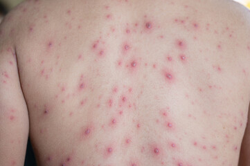 Portrait of sick little  boy. Varicella virus or Chickenpox bubble rash on child