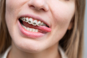 Close-up of a young woman's smile with metal braces on her teeth. Correction of bite