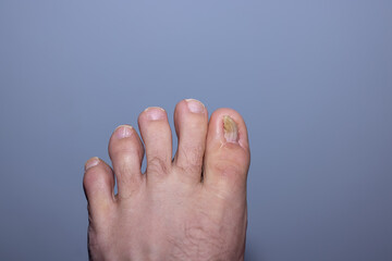 Aftermath of surgey to repair an ingrown toenail
