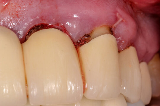 A Very Bad Case Of Periodontitis