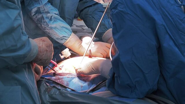 The hands of surgeons in latex gloves and blue uniforms hold special medical instruments during laparoscopic minimally invasive surgery. Treatment of proctological diseases.