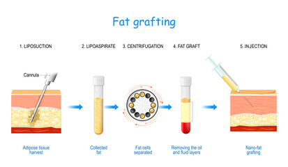 Fat grafting . Nano-fat injection