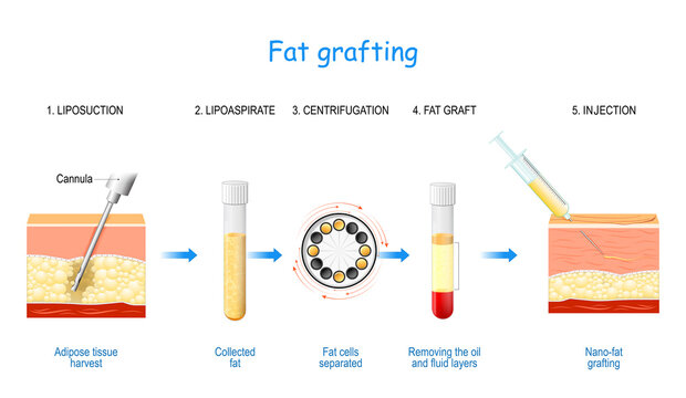 Fat Grafting . Nano-fat Injection