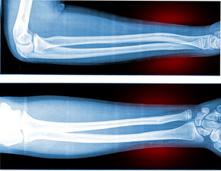 Film x-ray forearm and wrist joint (AP,LAT) closed fracture at distal part of diaphysis of radius with distal radioulnar joint.