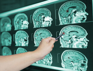 Close up Hand doctor point brian scan image of a recent traumatic brain injury patient showing brain contusion and hemorrhage.Medical image concept.
