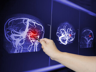 Close up Hand doctor point MRA brian scan image of a recent traumatic brain injury patient showing brain contusion and hemorrhage.Medical image concept.