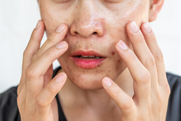 Close up of worried woman having problems of oily skin with acne inflamed on her face.