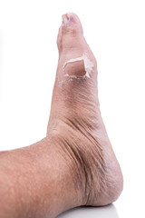 Fototapeta premium Recovered foot joint from gout attack with old skin peeling off from inflammed area.
