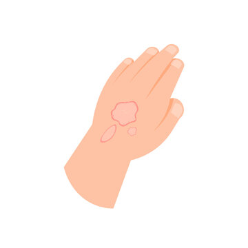 illustration of a hand affected by scurvy, ringworm, or skin disease. eczema symptoms. flat style. vector design