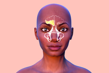 Purulent inflammation of frontal sinus in a female person