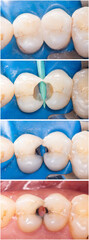 direct caries treatment by composite restoration